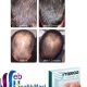 Buy Propecia Online